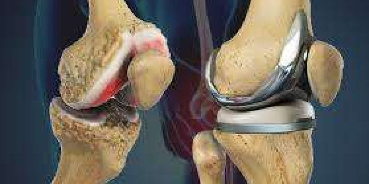 Global Knee Replacement Market Size And Forecast Report 2024-2032